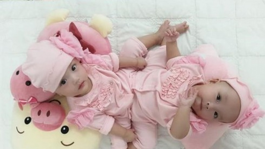 Conjoined twin girls to be separated in HCM City on July 15